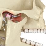 Skeletal view of TMJ join inflamed.