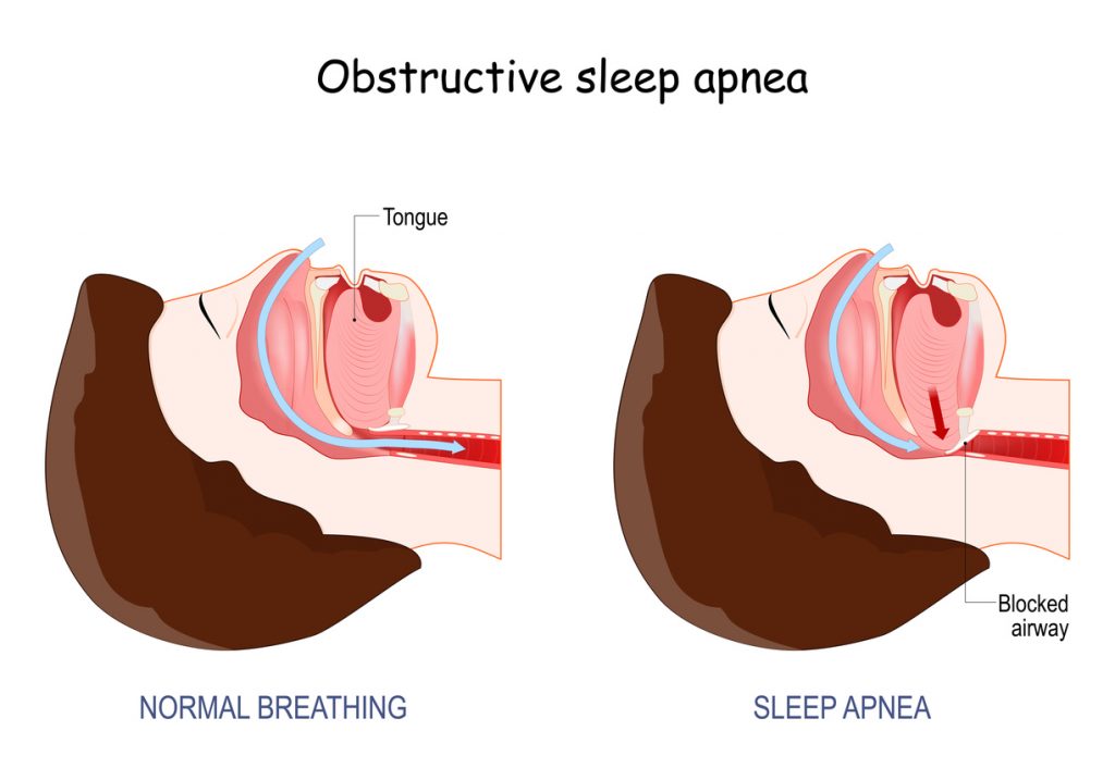 Obstructive Sleep Apnea, normal breathing and  anatomy of Snoring, Cross section of human's head