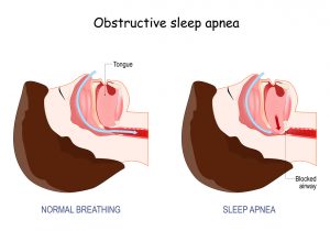 The Role of Sleep Apnea Dentists in Treating OSA